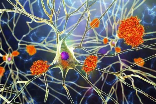 برخی داروهای دیابت پیشرفت آلزایمر را کند می کنند